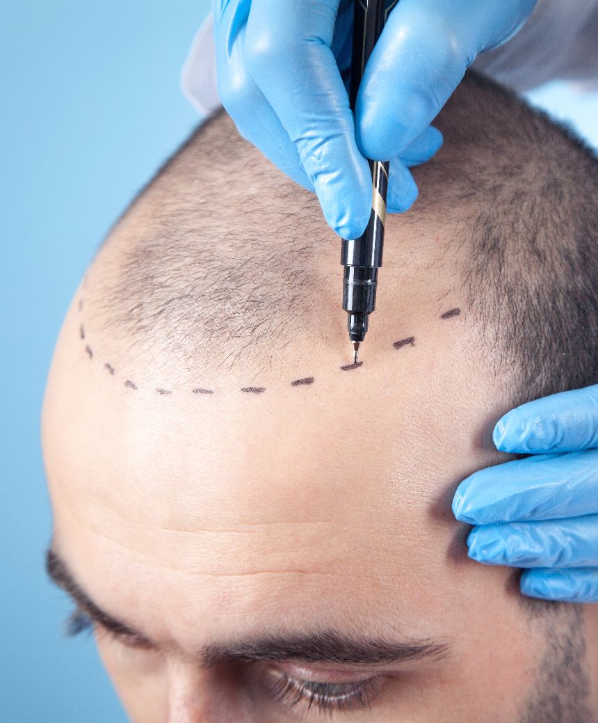 FUE Hair Transplant FUE Hair Transplant